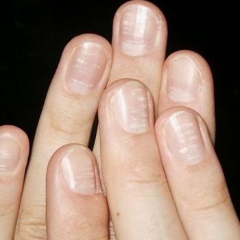 White Spotted Nails Care Tips
